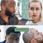 Panorama Hair Turkey: Hair Transplant Turkey Cost for an Affordable New Look