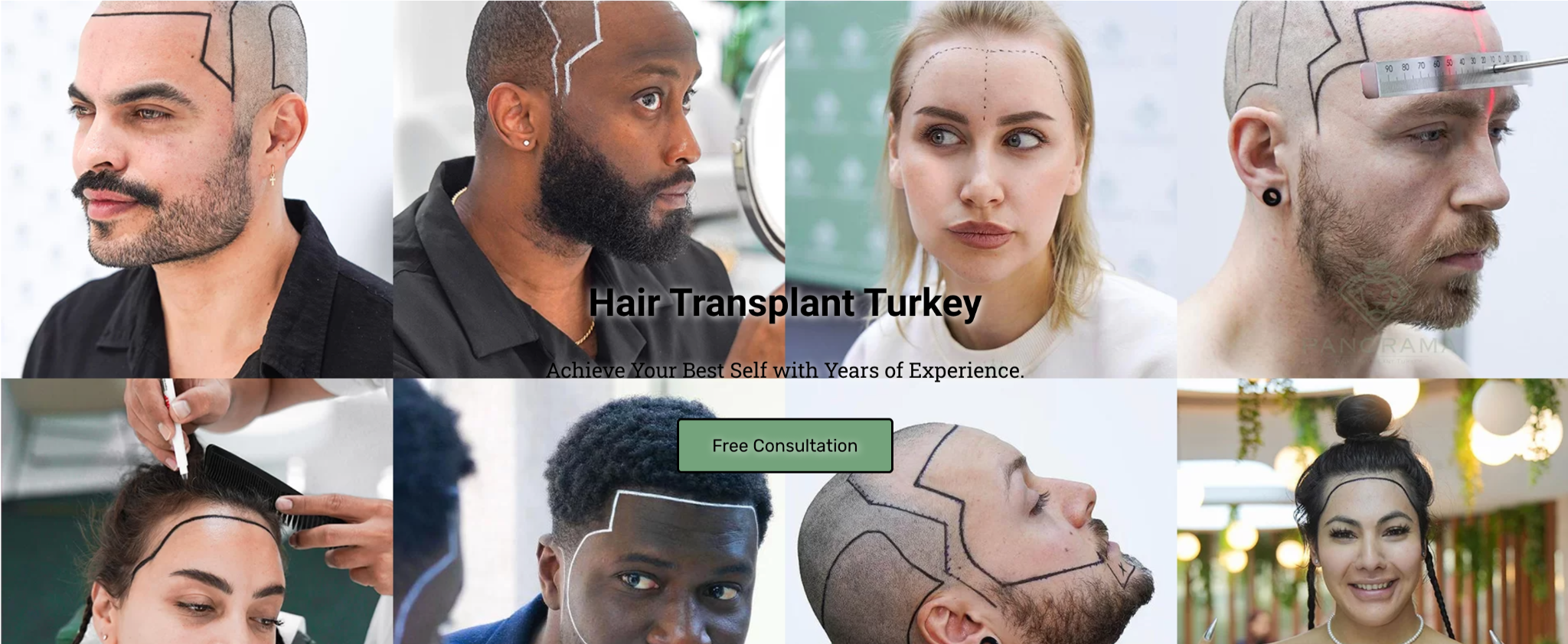 Panorama Hair Turkey: Hair Transplant Turkey Cost for an Affordable New Look